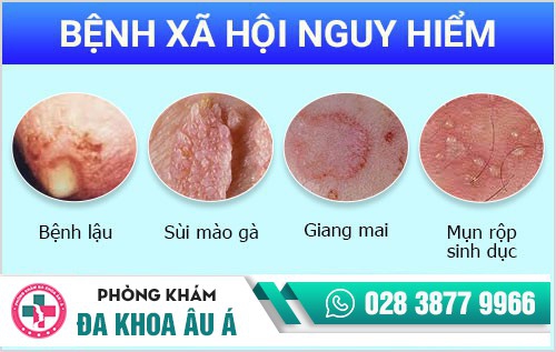 Đau buốt quy đầu do bệnh xã hội