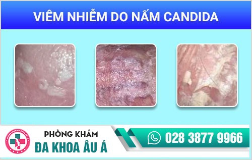Đau buốt quy đầu do nấm candida