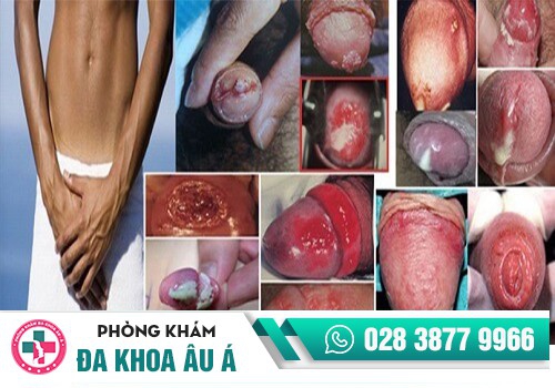 Đau buốt đầu dương vật