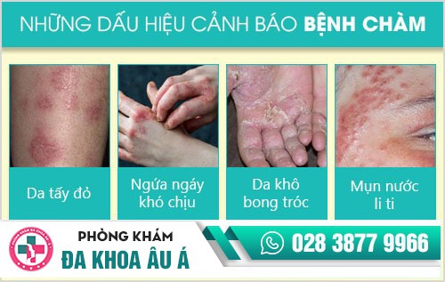 chữa bệnh chàm