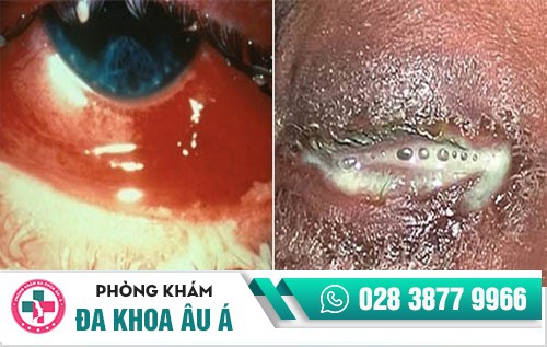 dấu hiệu bệnh lậu ở nam giới