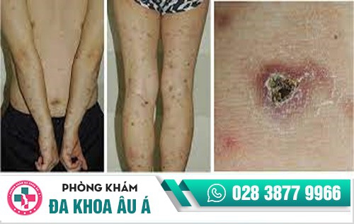 dấu hiệu bệnh lậu ở nam giới