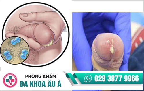 triệu chứng bệnh lậu ở nam giới