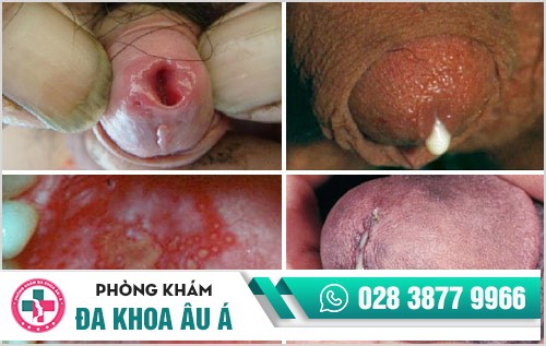 dấu hiệu bệnh lậu ở nam giới