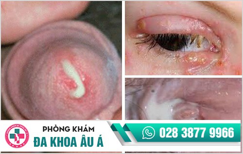 bệnh lậu tái phát