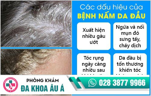 Dấu hiệu của bệnh nấm da đầu