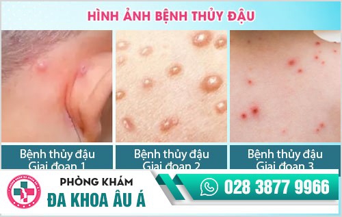 Nhận biết sớm các dấu hiệu của bệnh thủy đậu để điều trị đúng cách