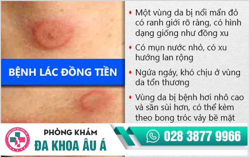 Lác đồng tiền