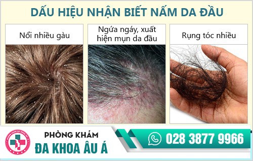 Cách chữa nấm da đầu hiệu quả chỉ trong 1 liệu trình