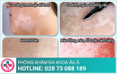 cách trị lang ben hiệu quả