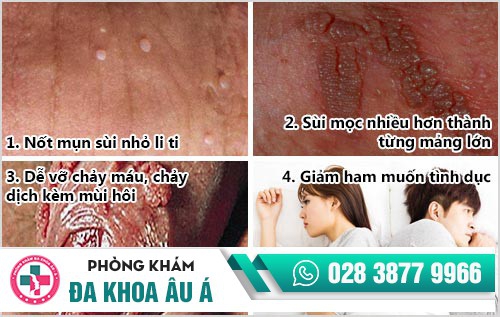 khám sùi mào gà ở đâu