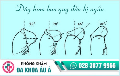 Dây hãm bao quy đầu bị ngắn