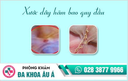 Dây hãm bao quy đầu bị đau và cách xử lý