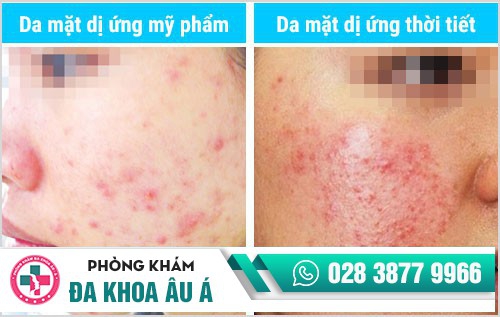 Cách trị dị ứng da mặt do mỹ phẩm, thời tiết