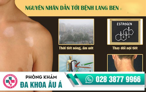 Điều trị lang ben bằng phương pháp tiên tiến