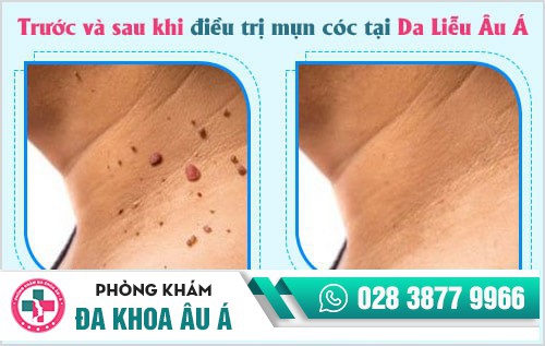 Nguyên nhân gây mụn cóc