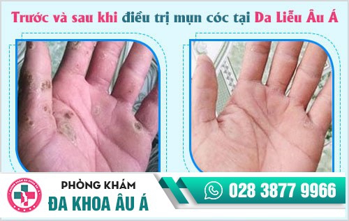 Nguyên nhân gây mụn cóc