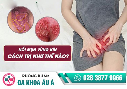 Mọc mụn ở âm đạo điều trị như thế nào?