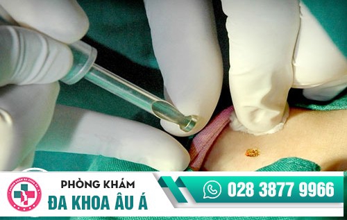 Đốt sùi mào gà bằng laser như thế nào tại Đa Khoa Âu Á? Đây chính là nỗi lo lắng của rất nhiều người vẫn chưa tiến hành điều trị dứt điểm.