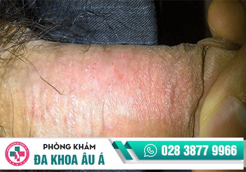 Dương vật bị sưng do nhiều nguyên nhân