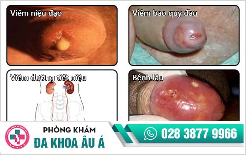 Dấu hiệu chảy dịch đầu dương vật
