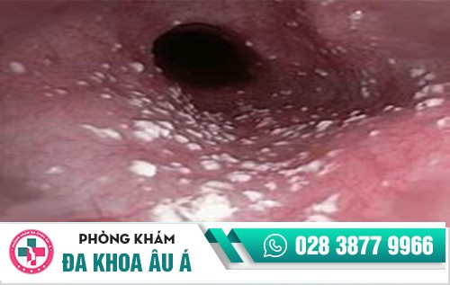 dương vật chảy mủ trắng đục