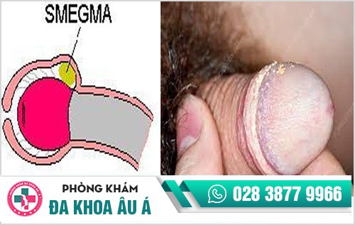 dương vật chảy mủ trắng đục