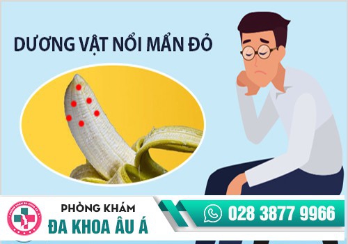 NỔI MẨN ĐỎ DƯƠNG VẬT – NGUY CƠ MẮC NHIỀU BỆNH NGUY HIỂM