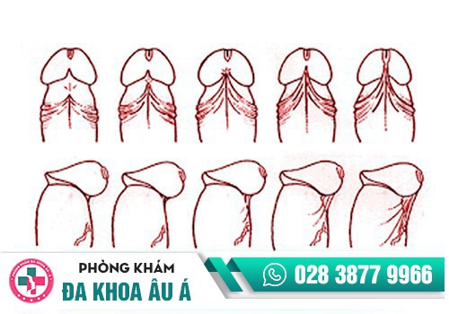    Đứt dây hãm quy đầu tác động tới tâm lý