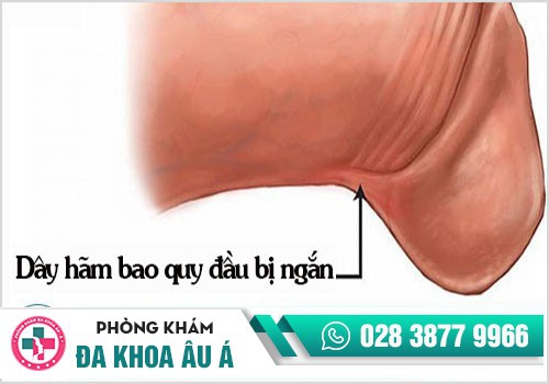 Đứt dây hãm bao quy đầu có thể khiến dương vật bị ngắn đi