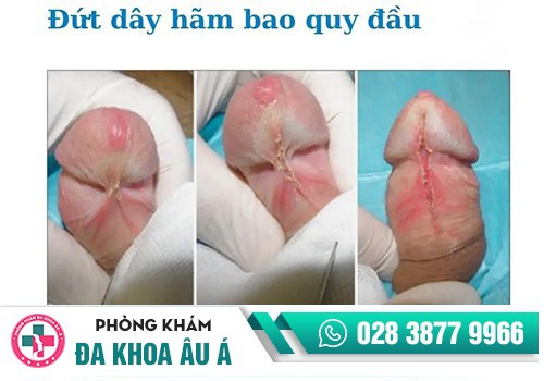 Hiện tượng bị đứt dây hãm bao quy đầu