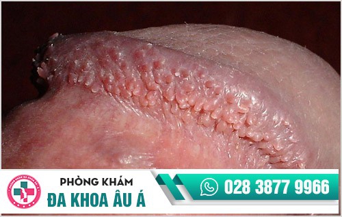 hình ảnh gai sinh dục