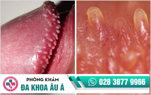 hình ảnh gai sinh dục