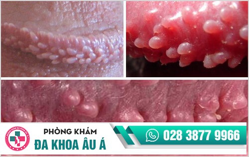 hình ảnh gai sinh dục