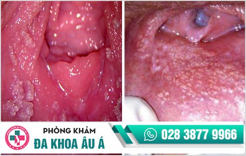 hình ảnh gai sinh dục