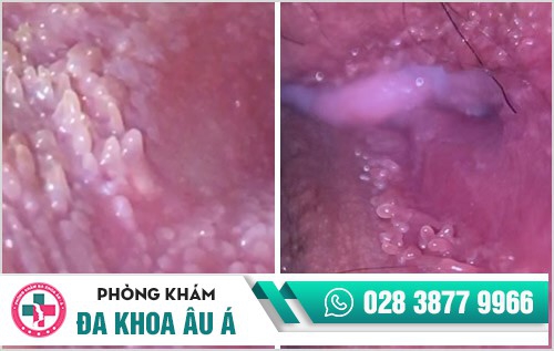 hình ảnh gai sinh dục