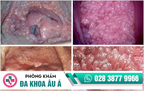 hình ảnh gai sinh dục