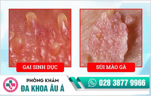 Đốt gai sinh dục bao nhiêu tiền? Đốt ở đâu giá rẻ, an toàn?