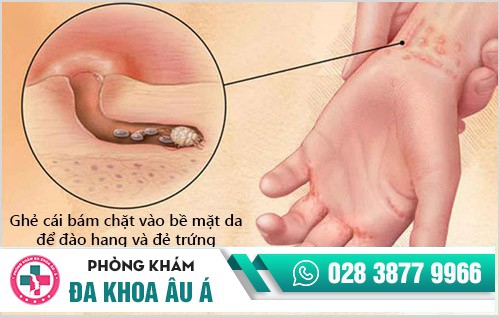 Hình ảnh bệnh ghẻ ngứa