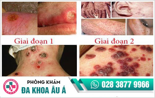 Giang mai ở nam giới, tỷ lệ lây nhiễm có xu hướng ngày càng tăng