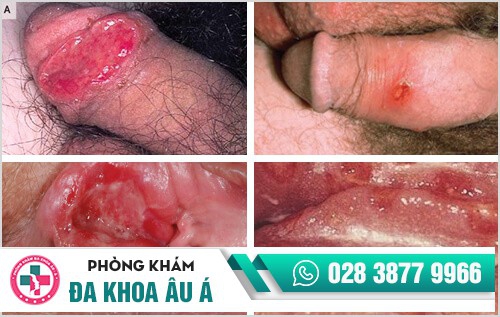 Khám bệnh giang mai ở đâu tốt nhất tại TP.HCM?
