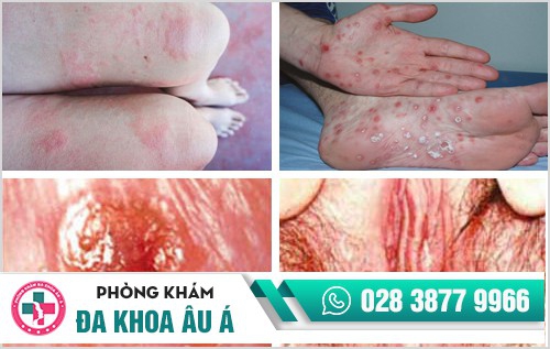 Cách nhận biết bệnh giang mai ở nữ qua từng giai đoạn