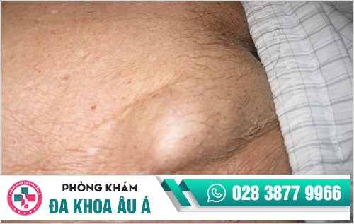 Nhận biết nhanh các biểu hiện bệnh giang mai