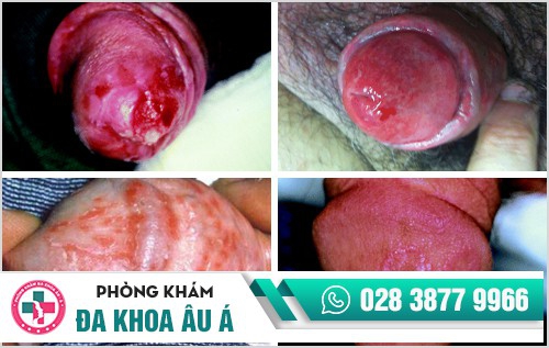 thuốc chữa trị hạt ngọc dương vật