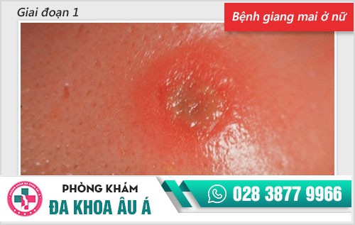 Chi tiết hình ảnh bệnh giang mai ở nam, nữ qua từng giai đoạn