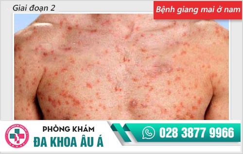 Chi tiết hình ảnh bệnh giang mai ở nam, nữ qua từng giai đoạn