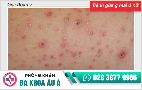 Chi tiết hình ảnh bệnh giang mai ở nam, nữ qua từng giai đoạn