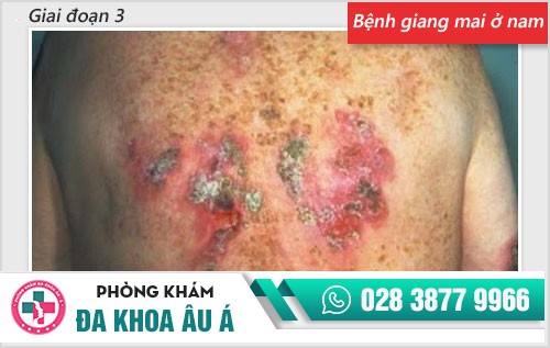 Chi tiết hình ảnh bệnh giang mai ở nam, nữ qua từng giai đoạn