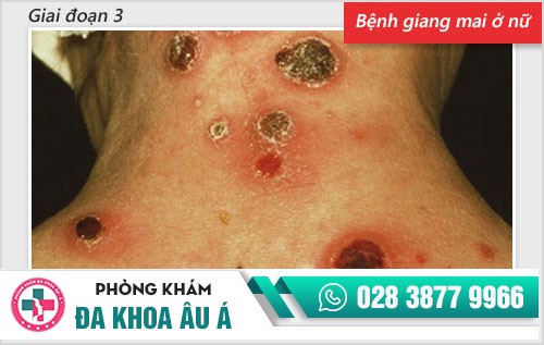 Chi tiết hình ảnh bệnh giang mai ở nam, nữ qua từng giai đoạn