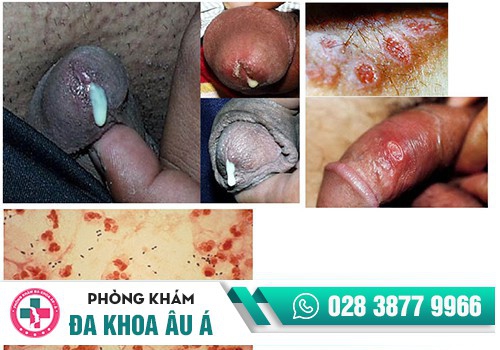 Bệnh xã hội dẫn đến tình trạng bí tiểu ở nam giới